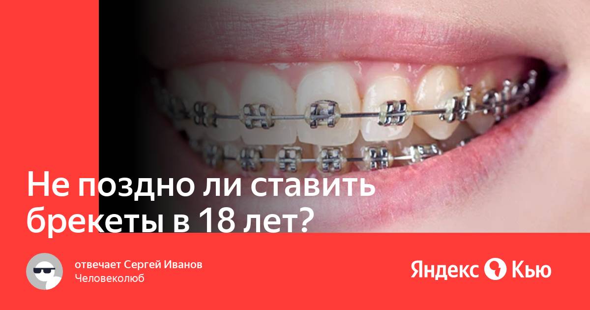 Когда можно ставить брекеты. Поздно ли в 30 лет ставить брекеты.